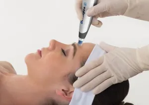 Dermapen Microneedling Skin Rejuvenation Full Face course of 4 1 FREE (save €250)